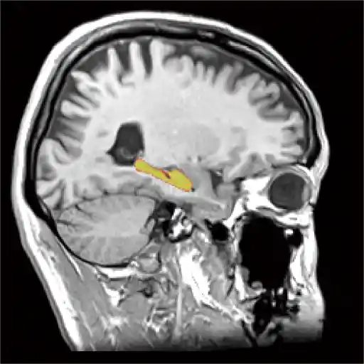 冠動脈狭窄CT画像1