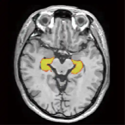 冠動脈狭窄CT画像2