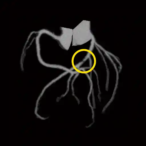 冠動脈狭窄CT画像2