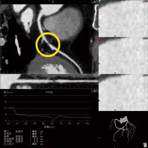 冠動脈狭窄CT画像3