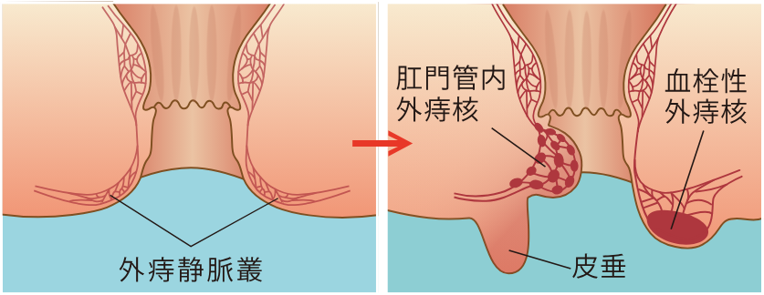 外痔静脈叢と外痔核