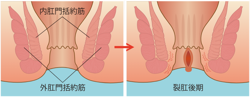 肛門括約筋と裂肛