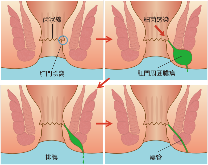 歯状線と肛門周囲膿瘍・痔ろう