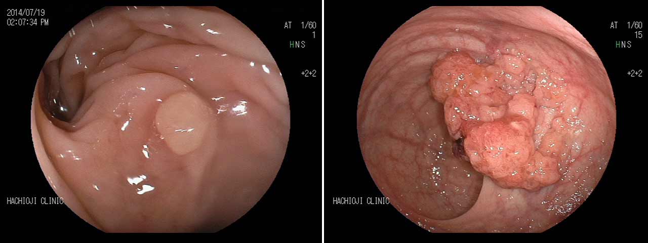 大腸ポリープと直腸がんの症例画像
