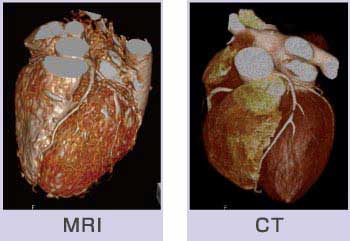 冠動脈撮影 MRIとCTの比較