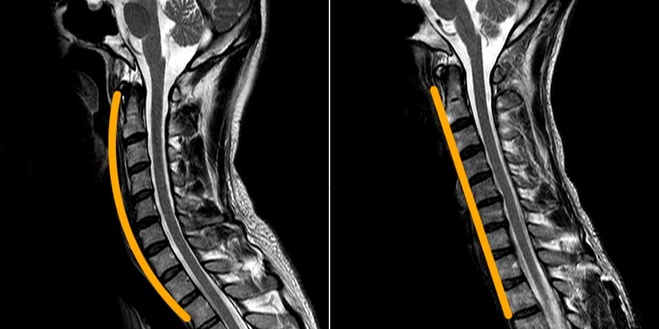 正常時頚椎とストレートネックの頚椎（MRI画像）