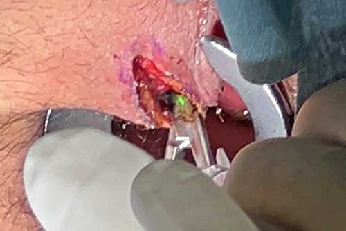 ドレナージ創を形成する写真