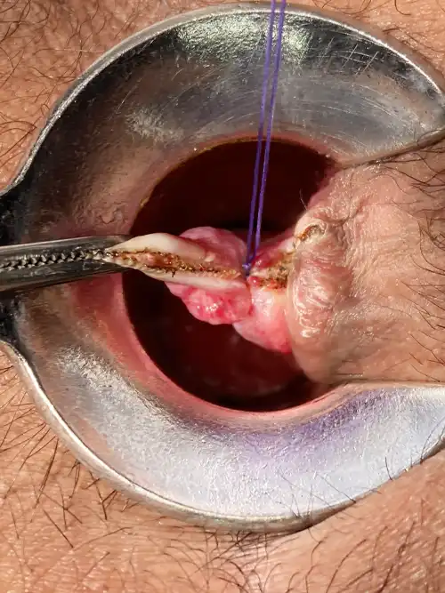 3時方向痔核切除の写真