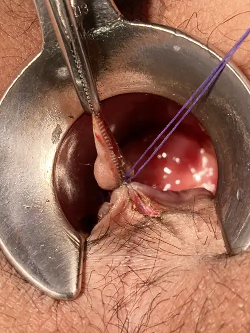 6時方向痔核切除の写真