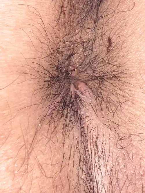 手術後1週間の写真