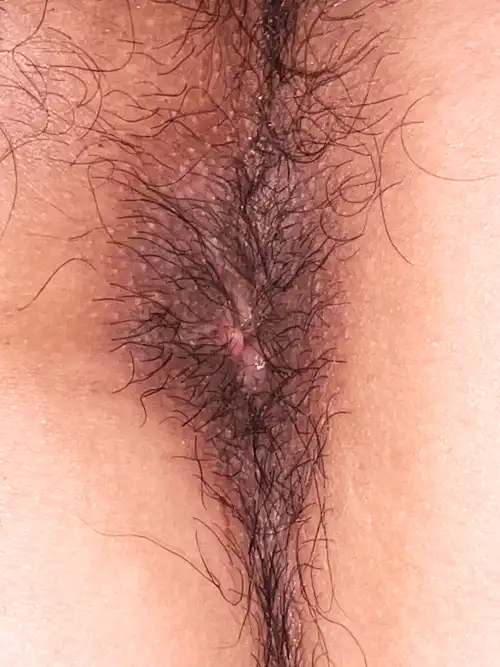 手術翌日の写真