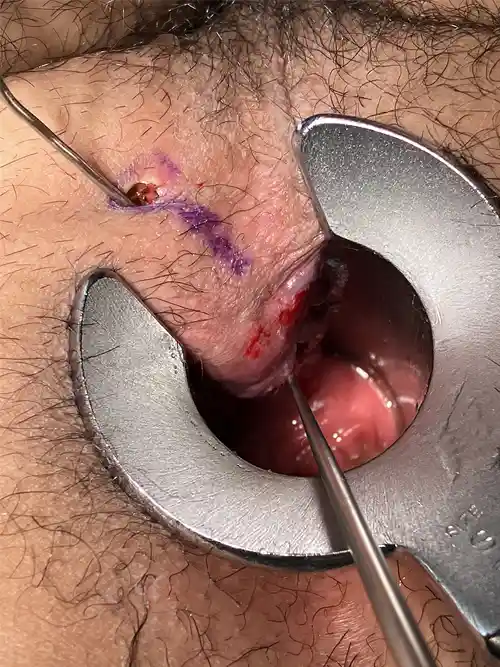 痔瘻手術前の写真