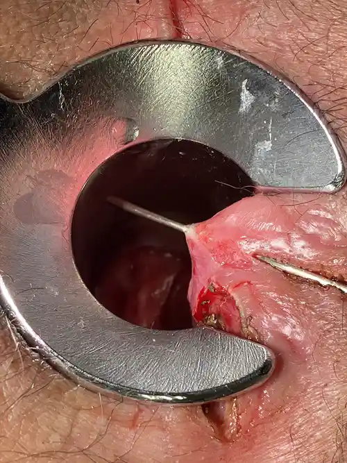 5時方向痔瘻の写真