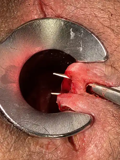 後壁を蒸散後の写真