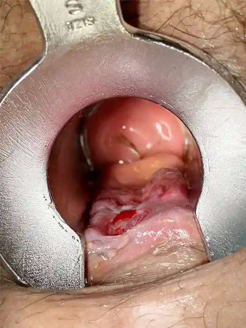 裂肛手術前の写真