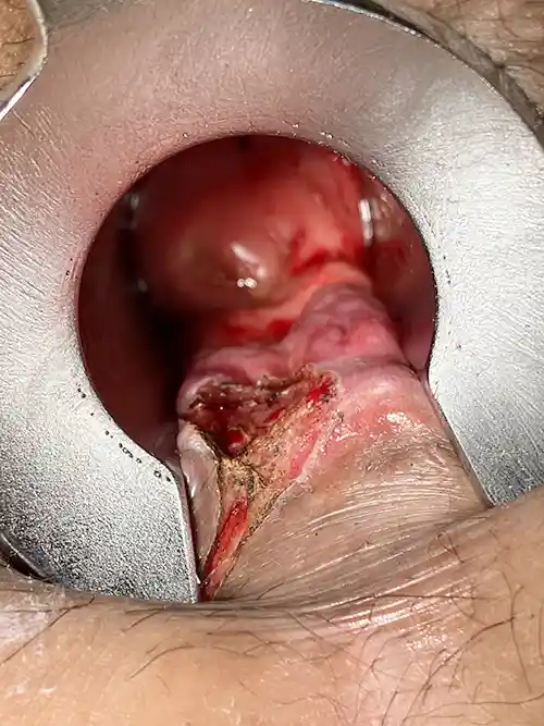 周堤を蒸散後の写真