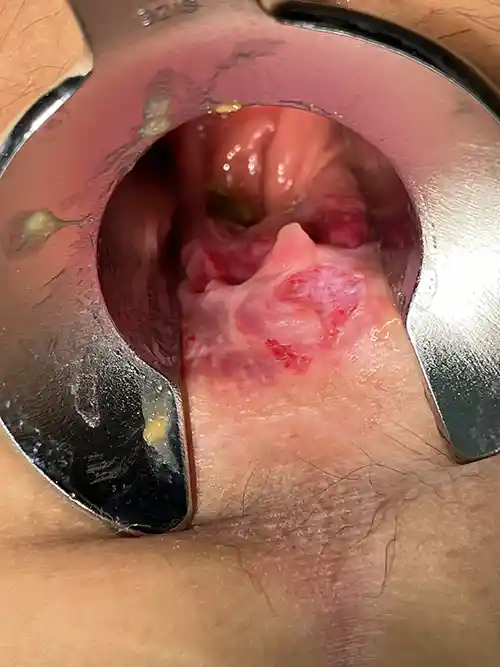 裂肛手術前の写真