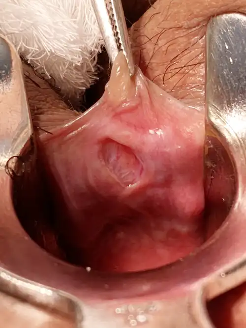 裂肛手術前の写真