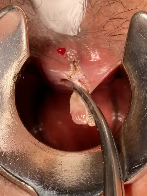 痔核切除の写真