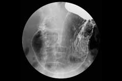 胃透視Ｘ線検査撮影画像