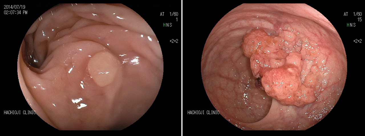 大腸内視鏡検査（大腸カメラ）