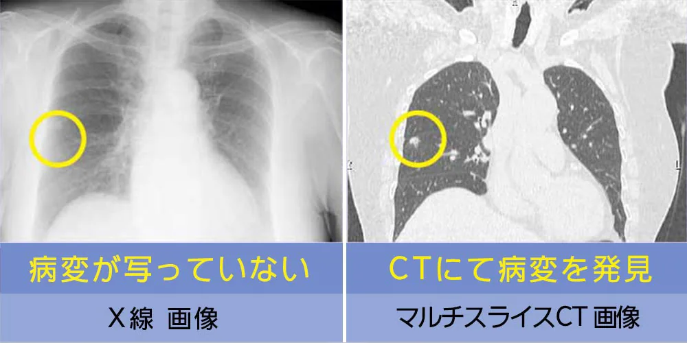 肺の病気