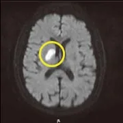 拡散強調撮影画像