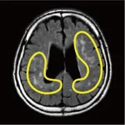 FLAIR撮影による脳MRI画像（隠れ脳梗塞の確認）