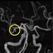 頭部MRA撮影による脳MRI画像（脳動脈瘤の確認）