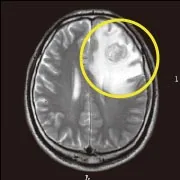 T2撮影による脳MRI画像（脳腫瘍の確認）