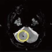 T2スター撮影による脳MRI画像（隠れ脳出血の確認）