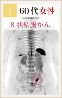 60代女性 S状結腸がんのドゥイブス画像