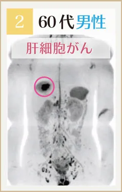 60代男性 肝細胞がんのドゥイブス画像
