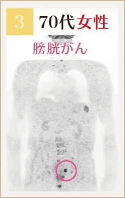70代女性 膀胱がんのドゥイブス画像