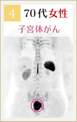 70代女性 子宮体がんのドゥイブス画像