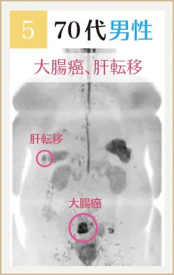 70代男性 大腸がん・肝転移のドゥイブス画像