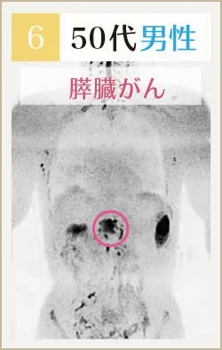 50代男性 膵臓がんのドゥイブス画像