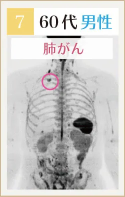 60代男性 肺がんのドゥイブス画像