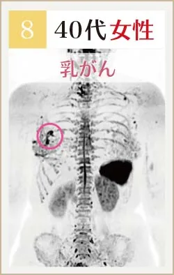 40代女性 乳がんのドゥイブス画像