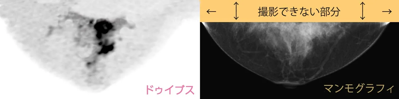 乳がん検査
