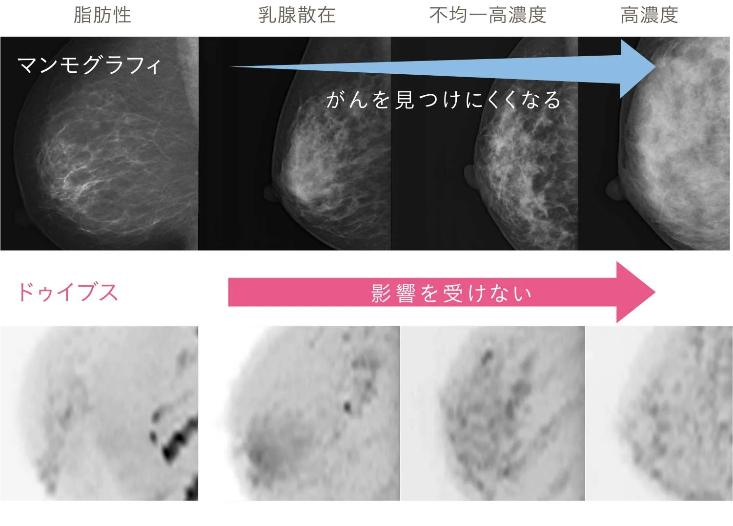 乳がん検査
