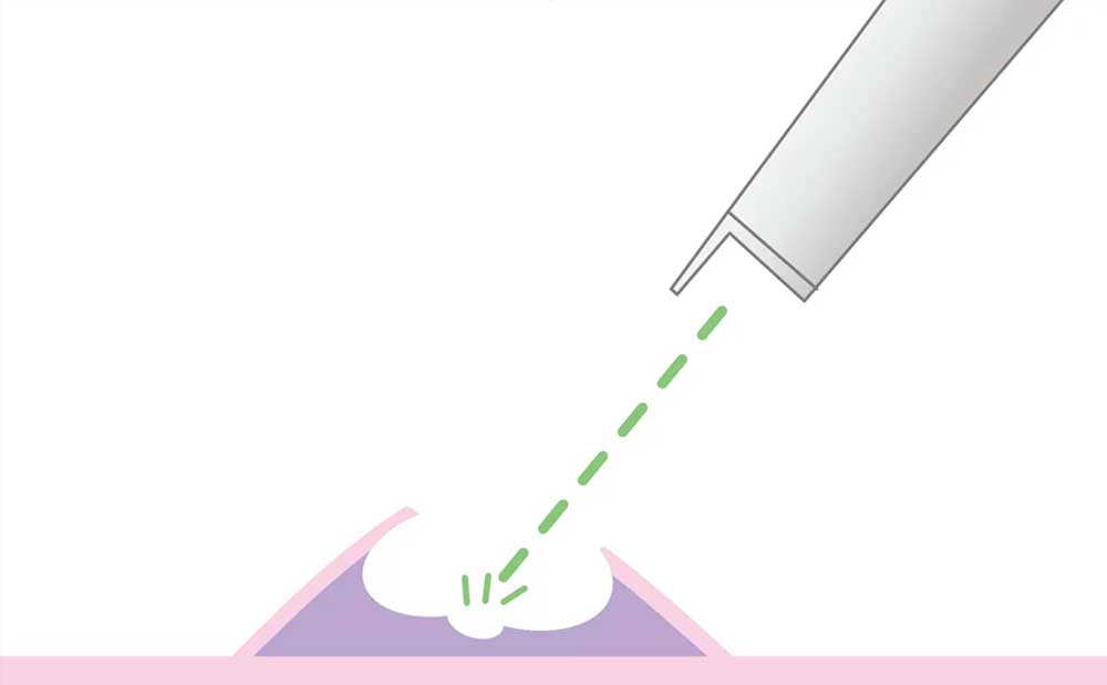 CO2レーザーメスの蒸散イメージ