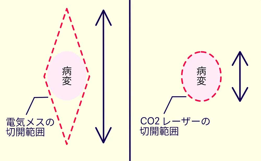 CO2レーザーメスの切除範囲