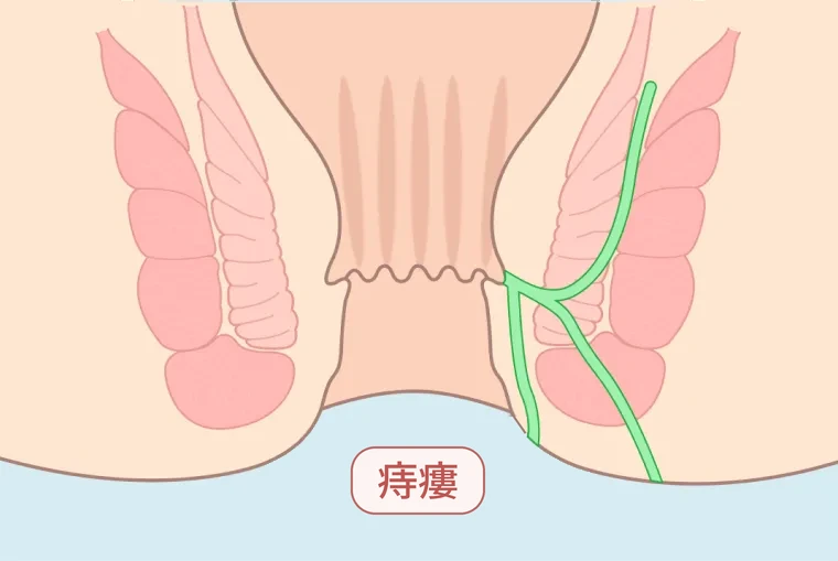 痔ろう（痔瘻）の図解