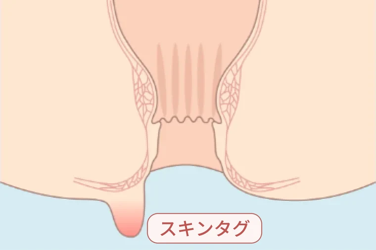スキンタグの図解