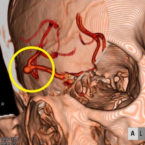 脳動脈瘤の3D-CT画像