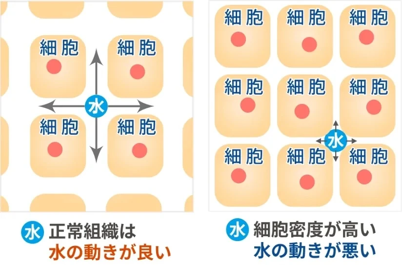 正常組織は水の動きが良い／細胞密度が高いと水の動きが悪い
