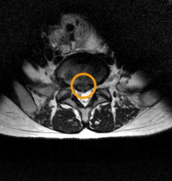 72歳男性の腰椎椎間板ヘルニアMRI画像