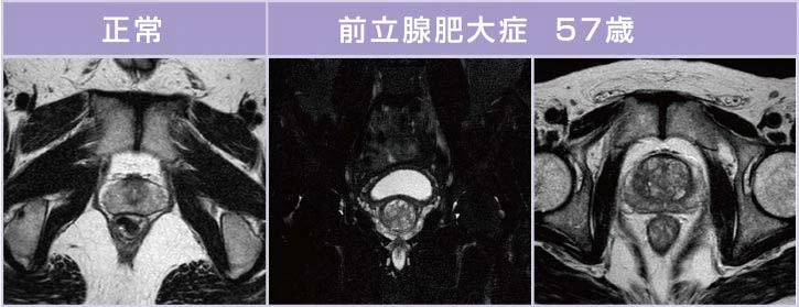 前立腺MRI検査の画像