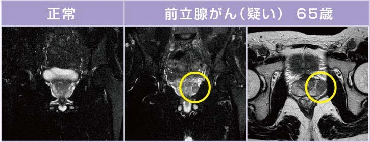 前立腺MRI検査の画像